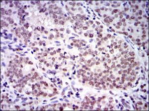 ab124473, at 1/200 dilution, staining Skp1 in paraffin-embedded Human cervical cancer tissue by immunohistochemistry followed by DAB staining.