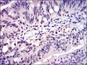 ab119912 at 1/200 dilution staining Skp1 in paraffin-embedded Human rectum cancer tissue by Immunohistochemistry followed by DAB staining.