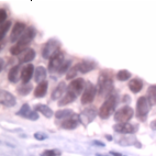 Ab41866 staining human Skp1 in human breast carcinoma by immunohistochemistry using formalin fixed paraffin embedded tissue.