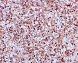 immunohistochemical analysis of paraffin embedded Human kidney clear cell carcinoma tissue labeling SKP2 with ab183039 at 1/50 followed by secondary staining with Ready to use HRP Polymer for Rabbit IgG and counterstained with Hematoxylin.