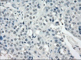 Immunohistochemical staining of paraffin embedded Human Adenocarcinoma of breast tissue, using ab117972 at a dilution of 1/50.