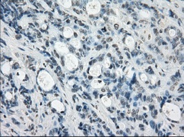 Immunohistochemical staining of paraffin embedded Human Adenocarcinoma of colon tissue, using ab117972 at a dilution of 1/50.