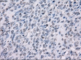 Immunohistochemical staining of paraffin embedded Human Carcinoma of bladder tissue, using ab117972 at a dilution of 1/50.
