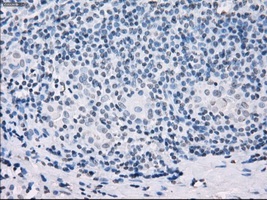 Immunohistochemical staining of paraffin embedded Human Carcinoma of thyroid tissue, using ab117972 at a dilution of 1/50.