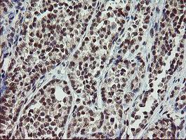 Immunohistochemical analysis of paraffin embedded Carcinoma of Human thyroid tissue labelling SLAP2 with ab131571 antibody at a dilution of 1/150.