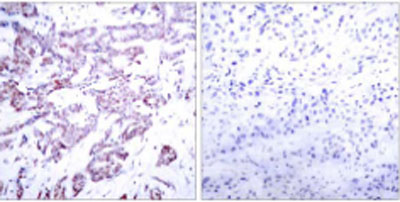 ab30650 staining human STAT6 in breast carcinoma by Immunohistochemistry, Paraffin embedded tissue. Left image antibody un-treated. Right image antibody pre-incubated with synthetic phosphopeptide.