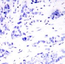 Immunohistochemistry (Formalin-fixed paraffin-embedded sections) of breast carcinom using ab28829 preincubated with synthesised phospho-peptide.