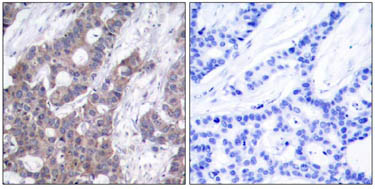ab47328 staining human breast carcinoma tissue by IHC-P (left hand panel). The right hand panel shows staining in the presence of phospho-peptide.
