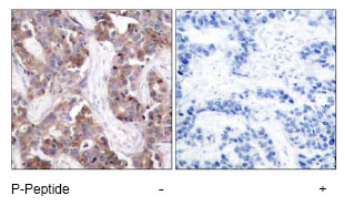 Immunohistochemical analysis of paraffin-embedded human breast carcinoma tissue using ab47398 at a 1/50 dilution. Left image : Un-treated Right image : Treated with P-Peptide