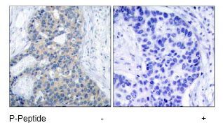Immunohistochemical analysis of paraffin-embedded human breast carcinoma tissue using ab47399 at a 1/50 dilution. Left image: Untreated Right image: Treated with phosphopeptide