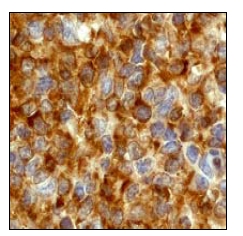Immunohistochemical analysis of Stathmin 1 in paraffin embedded human tonsil tissue using ab52906 at 1/250 dilution.Immunohistochemical analysis of Stathmin 1 in paraffin embedded human tonsil tissue using ab52906 at 1/250 dilution.