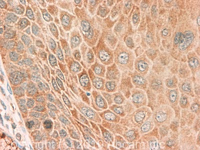 IHC image of Staufen staining in Human Cervical Cancer FFPE section, performed on a BondTM system using the standard protocol F. The section was pre-treated using heat mediated antigen retrieval with sodium citrate buffer (pH6, epitope retrieval solution 1) for 20 mins. The section was then incubated with ab73478, 5µg/ml, for 15 mins at room temperature and detected using an HRP conjugated compact polymer system. DAB was used as the chromogen. The section was then counterstained with haematoxylin and mounted with DPX