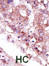 ab5519 staining STK33 in human hepatocarcinoma (HC) tissue by Immunohistochemistry (Formalin/PFA-fixed paraffin-embedded sections).