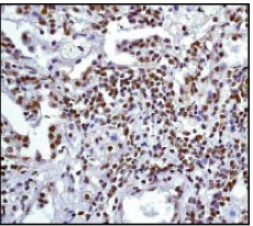 IHC of paraffin-embedded human lung carcinoma using anti-SUMO 1 (ab32058) diluted 1:250