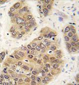 Immunohistochemical analysis of formalin-fixed, paraffin-embedded Human hepatocarcinoma tissue, labeling SUMO4 using ab170850 at a 1/50 dilution, followed by peroxidase-conjugation of the secondary antibody and DAB staining.