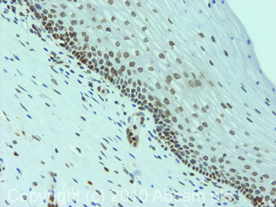 IHC image of Ab65447 staining in Human Cervical Carcinoma formalin fixed paraffin embedded tissue section, performed on a Leica BondTM system using the standard protocol F. The section was pre-treated using heat mediated antigen retrieval with sodium citrate buffer (pH6, epitope retrieval solution 1) for 20 mins. The section was then incubated with Ab65447, 5µg/ml, for 15 mins at room temperature and detected using an HRP conjugated compact polymer system. DAB was used as the chromogen. The section was then counterstained with haematoxylin and mounted with DPX. For other IHC staining systems (automated and non-automated) customers should optimize variable parameters such as antigen retrieval conditions, primary antibody concentration and antibody incubation times.
