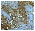 Ab51254 (1:100) staining human Superoxide Dismutase 1 in human breast carcinoma tissue by immunohistochemistry using paraffin embedded tissue.