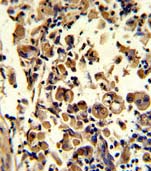 Immunohistochemical analysis of formalin-fixed, paraffin-embedded Human lung carcinoma tissue labelling Superoxide Dismutase 3 with ab135790 at 1/50 dilution, followed by peroxidase-conjugated secondary antibody and DAB staining.