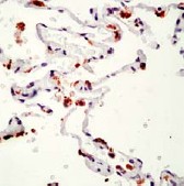 Immunohistochemistry (Formalin/PFA-fixed paraffin-embedded sections) using ab17946 and lung adenocarcinoma as a positive control.