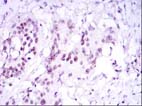Immunohistochemical analysis of SUZ12 in paraffin embedded Human esophageal cancer tissues, using ab107249 at a 1/200 dilution with DAB staining.