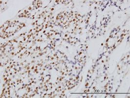 Symplekin antibody (ab56453) used in immunohistochemistry at 3ug/ml on formalin fixed and paraffin embedded human ovary, clear cell carcinoma.