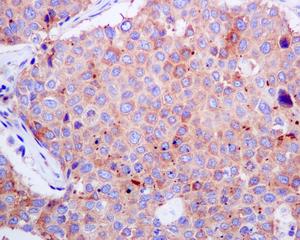 Immunohistochemical analysis of paraffin-embedded, formalin-fixed Human lung adenocarcinoma tissue, labelling Syntaxin 16 using ab134945 at a 1/50 dilution.