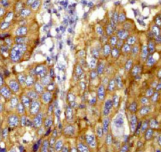 ab40674 at a 1:250 dilution staining Synip in human lung carcinoma.