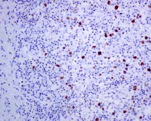 Immunohistochemical analysis of paraffin embedded Human Hodgkin's lymphoma tissue using ab150440 showing +ve staining.
