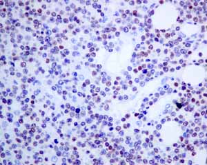 Immunohistochemical analysis of paraffin embedded Human T cell lymphoma tissue using ab150440 showing +ve staining.