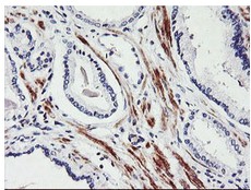 ab119754, at 1/150 dilution, staining Tal1 in formalin-fixed, paraffin-embedded Carcinoma of Human prostate tissue by Immunohistochemistry.