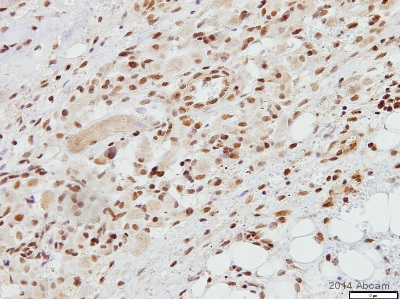 ab63766 staining TAT binding protein TBP in human infantile fibromatosis tissue sections by Immunohistochemistry (IHC-P - paraformaldehyde-fixed, paraffin-embedded sections). Tissue was fixed with formaldehyde and blocked with 1% FBS/BSA for 3 hours at room temperature; antigen retrieval was by heat mediation in Tris pH9. Samples were incubated with primary antibody (1/100 in TBS + 1% BSA + 1% FBS) for 16 hours. An undiluted HRP-conjugated goat anti-rabbit IgG polyclonal was used as the secondary antibody.See Abreview