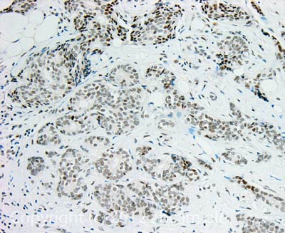 IHC image of TATA binding protein TBP staining in Human breast ductal carcinoma formalin fixed paraffin embedded tissue section, performed on a Leica BondTM system using the standard protocol F. The section was pre-treated using heat mediated antigen retrieval with sodium citrate buffer (pH6, epitope retrieval solution 1) for 20 mins. The section was then incubated with ab63766, 10µg/ml, for 15 mins at room temperature and detected using an HRP conjugated compact polymer system. DAB was used as the chromogen. The section was then counterstained with haematoxylin and mounted with DPX.For other IHC staining systems (automated and non-automated) customers should optimize variable parameters such as antigen retrieval conditions, primary antibody concentration and antibody incubation times.