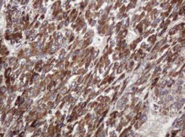Immunohistochemical analysis of paraffin-embedded Human liver carcinoma tissue, labelling TBC1D13 with ab140522 at 1/150 dilution.