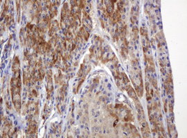 Immunohistochemical analysis of paraffin-embedded Human thyroid carcinoma tissue, labelling TBC1D13 with ab140522 at 1/150 dilution.