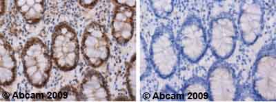ab62487 staining TBC1D4 in human colon.Left panel: with primary antibody at 4 ug/ml. Right panel: isotype control.Sections were stained using an automated system (DAKO Autostainer Plus), at room temperature: sections were rehydrated and antigen retrieved with the Dako 3 in 1 AR buffers EDTA pH 9.0. Slides were peroxidase blocked in 3% H2O2 in methanol for 10 mins. They were then blocked with Dako Protein block for 10 minutes (containing casein 0.25% in PBS) then incubated with primary antibody for 20 min and detected with Dako envision flex amplification kit for 30 minutes. Colorimetric detection was completed with Diaminobenzidine for 5 minutes. Slides were counterstained with Haematoxylin and coverslipped under DePeX. Please note that for manual staining we recommend to optimize the primary antibody concentration and incubation time (overnight incubation), and amplification may be required.
