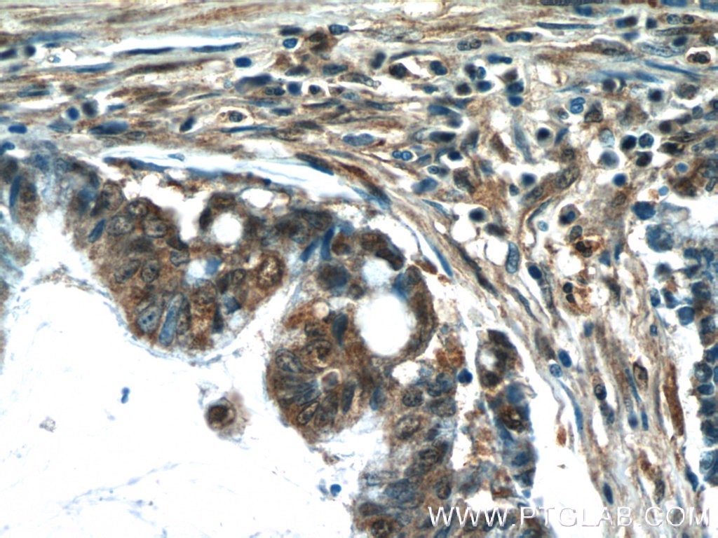 Immunohistochemistry of paraffin-embedded human colon cancer tissue slide using 24975-1-AP( C10orf68 Antibody) at dilution of 1:50 (under 40x lens)