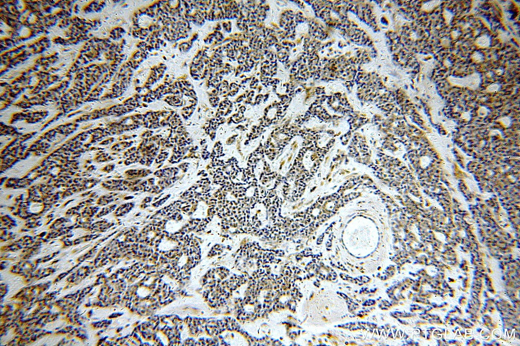 Immunohistochemical of  paraffin-embedded human cervical cancer using 19892-1-AP(C12orf11 antibody) at dilution of 1:100 (under 10x lens)