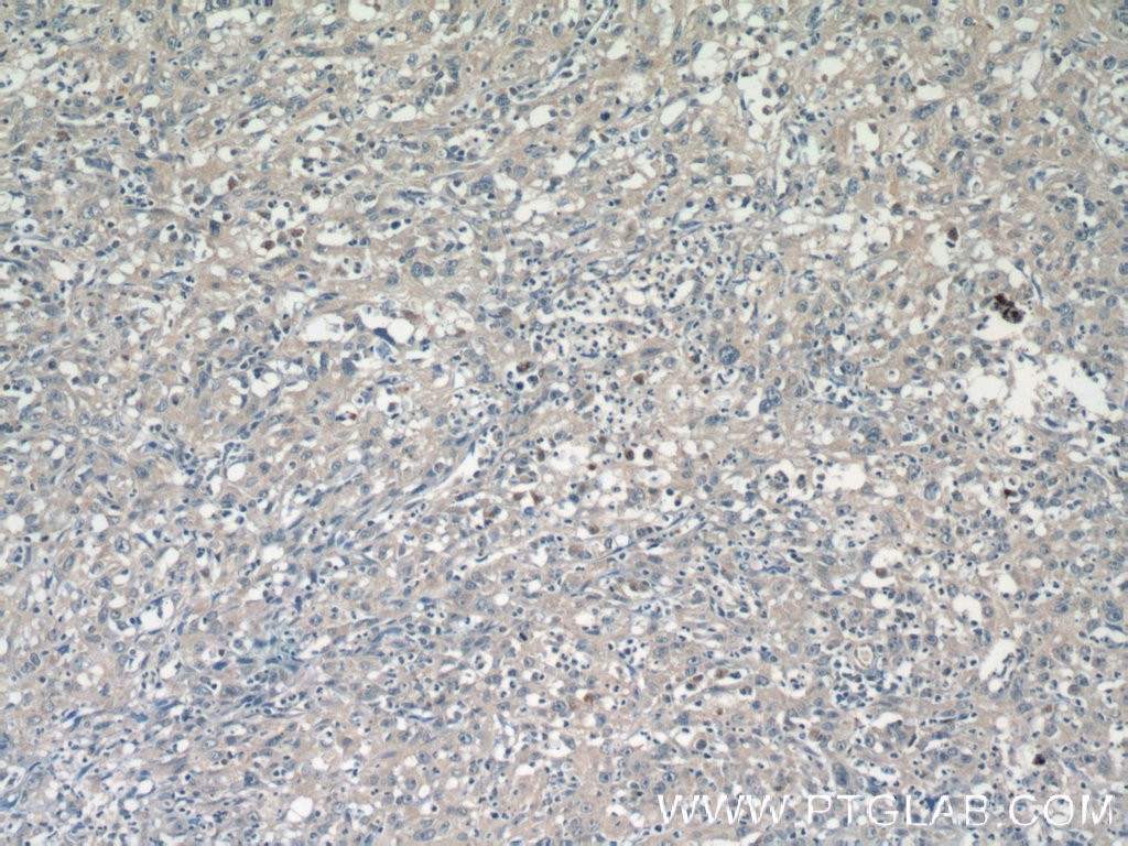 Immunohistochemistry of paraffin-embedded human cervical cancer tissue slide using 16679-1-AP( C19orf24 Antibody) at dilution of 1:50 (under 10x lens)