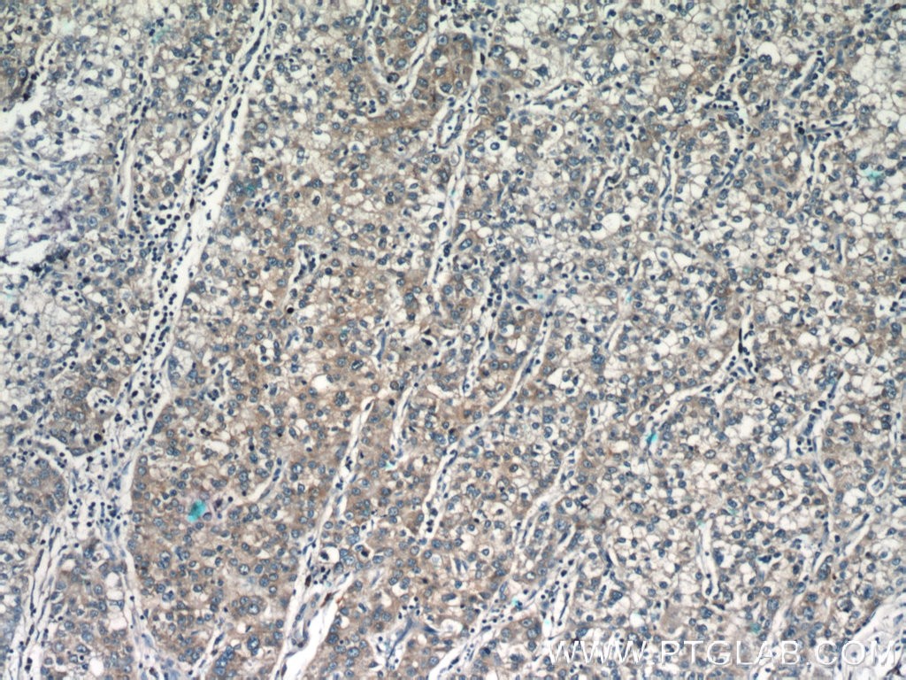 Immunohistochemistry of paraffin-embedded human liver cancer slide using 23178-1-AP( MGME1 Antibody) at dilution of 1:50 (under 10x lens)