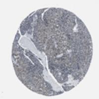 Immunohistochemistry: SETD5 Antibody - Strong cytoplasmic and nuclear staining was observed in glandular cells of the gastrointestinal tract, parathyroid and thyroid glands, adrenal cortex and upper airway epithelium. The remaining normal tissues generally displayed weak to moderate nuclear and/or cytoplasmic positivity. Cells of the liver were negative. Among tumors, most cases showed weak to moderate nuclear and/or cytoplasmic positivity. Some malignant gliomas and malignant carcinoids showed strong nuclear staining. Most renal and endometrial cancers were negative. Image and statement courtesy of the Human Protein Atlas (HPA).