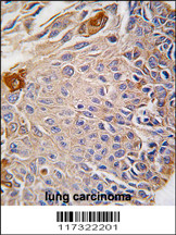 Formalin-fixed and paraffin-embedded human lung carcinoma reacted with RMND5B antibody (C-term), which was peroxidase-conjugated to the secondary antibody, followed by DAB staining. This data demonstrates the use of this antibody for immunohistochemistry; clinical relevance has not been evaluated.