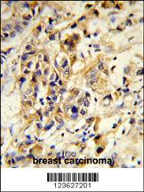 Formalin-fixed and paraffin-embedded human breast carcinoma reacted with RPGRIP1 Antibody (Center), which was peroxidase-conjugated to the secondary antibody, followed by DAB staining. This data demonstrates the use of this antibody for immunohistochemistry; clinical relevance has not been evaluated.