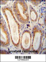 WFDC12 antibody (C-term) (Cat# 102-10629) immunohistochemistry analysis in formalin fixed and paraffin embedded human prostate carcinoma followed by peroxidase conjugation of the secondary antibody and DAB staining. This data demonstrates the use of the WFDC12 antibody (C-term) for immunohistochemistry. Clinical relevance has not been evaluated.