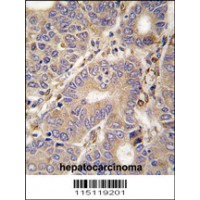 Formalin-fixed and paraffin-embedded human hepatocarcinoma tissue reacted with CARS2 antibody , which was peroxidase-conjugated to the secondary antibody, followed by DAB staining.
