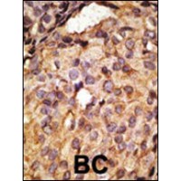 Formalin-fixed and paraffin-embedded human cancer tissue reacted with the primary antibody, which was peroxidase-conjugated to the secondary antibody, followed by AEC staining. BC = breast carcinoma; HC = hepatocarcinoma.