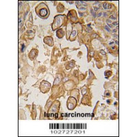 Formalin-fixed and paraffin-embedded human lung carcinoma tissue reacted with Mouse TLR6 antibody , which was peroxidase-conjugated to the secondary antibody, followed by DAB staining.