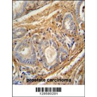 PCOTH antibody immunohistochemistry analysis in formalin fixed and paraffin embedded human prostate carcinoma followed by peroxidase conjugation of the secondary antibody and DAB staining.