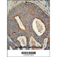 POTEB antibody immunohistochemistry analysis in formalin fixed and paraffin embedded human prostate carcinoma followed by peroxidase conjugation of the secondary antibody and DAB staining.