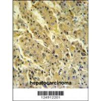 PSG7 Antibody IHC analysis in formalin fixed and paraffin embedded hepatocarcinoma followed by peroxidase conjugation of the secondary antibody and DAB staining.