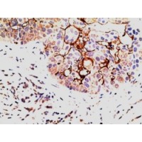 Immunohistochemistry (5μg/ml) staining of paraffin embedded Human Breast Carcinoma. Steamed antigen retrieval with citrate buffer pH 6, AP-staining.